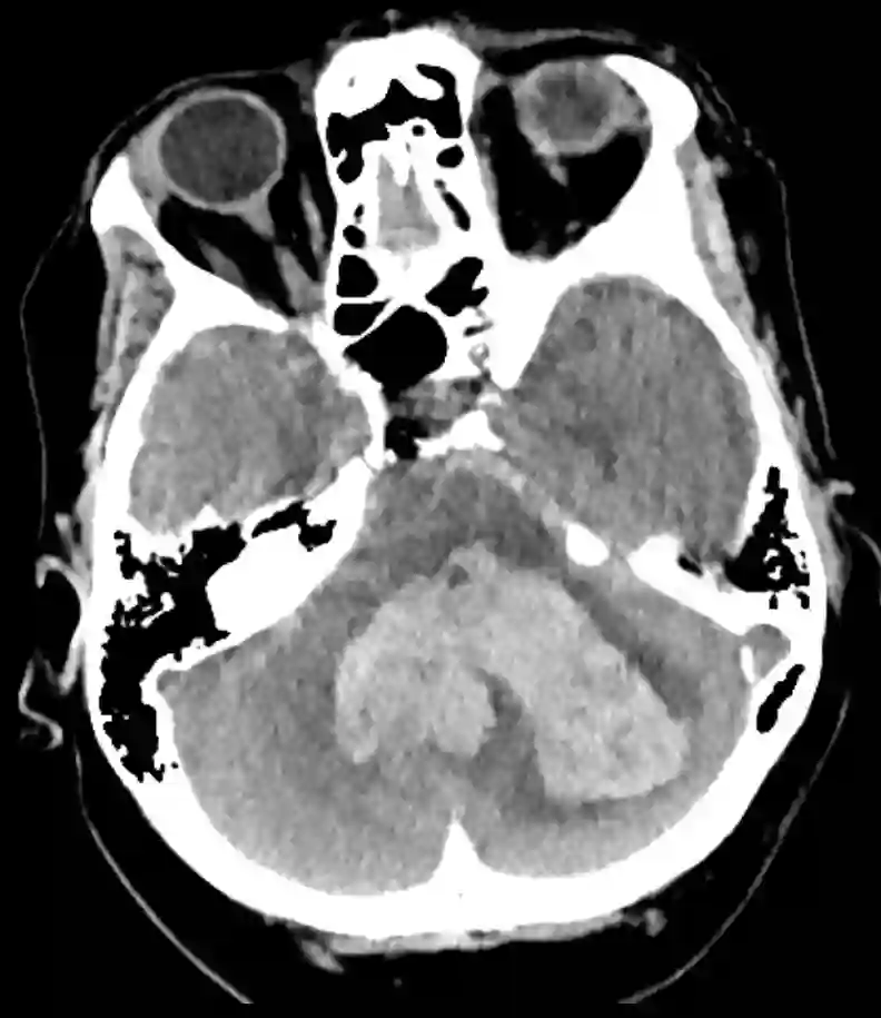 Cerebelläre Blutung im CT