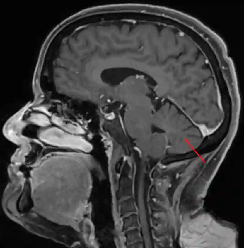 Cerebellum im sagittalen MRI.