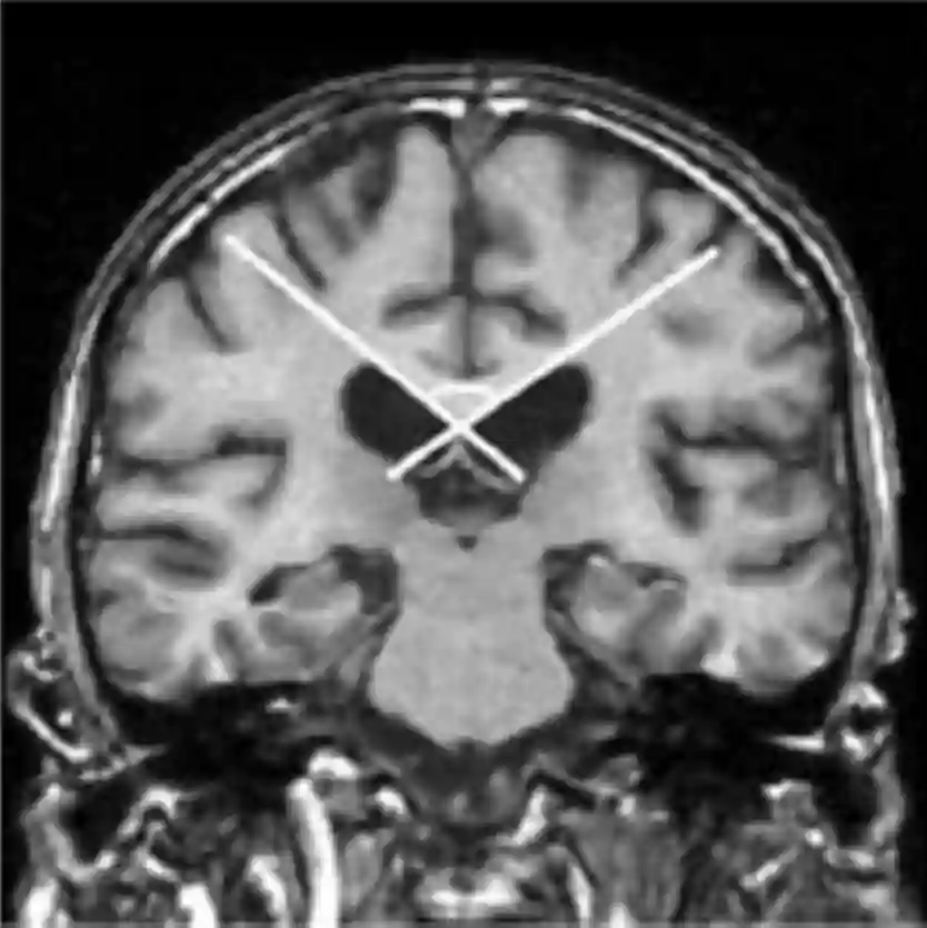 Corpus callosum Winkel MRI