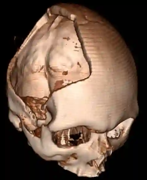 CT Rekonstruktion dekompressive Hemikraniektomie