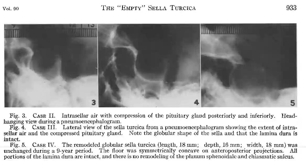 Empty Sella Syndrom