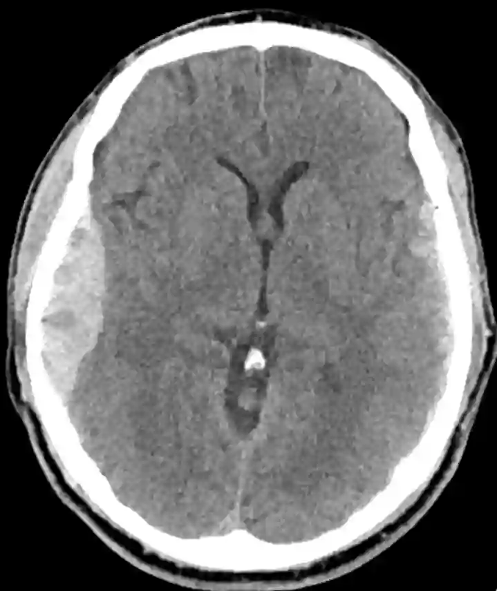 Epiduralhämatom im CT