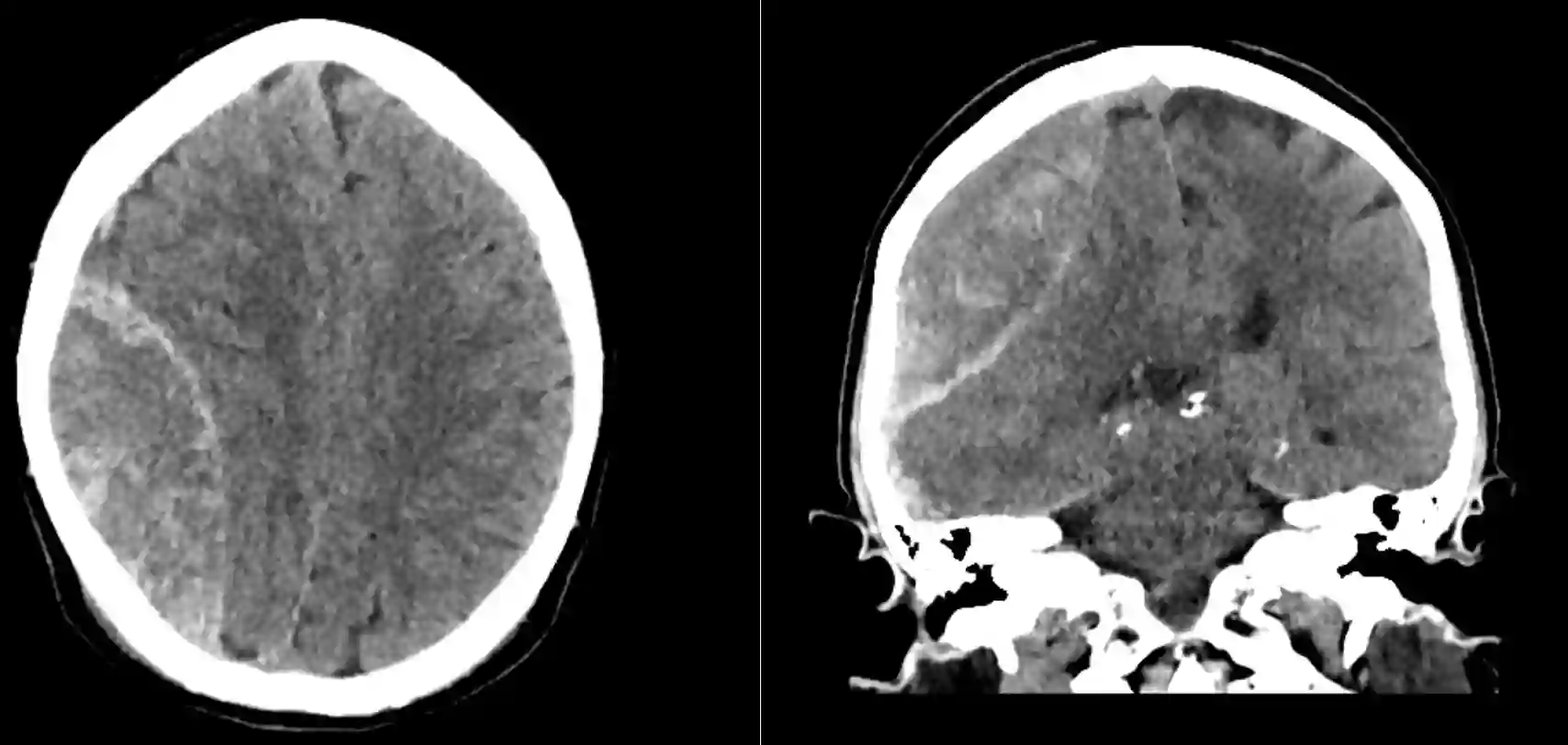 Epiduralhämatom im CT