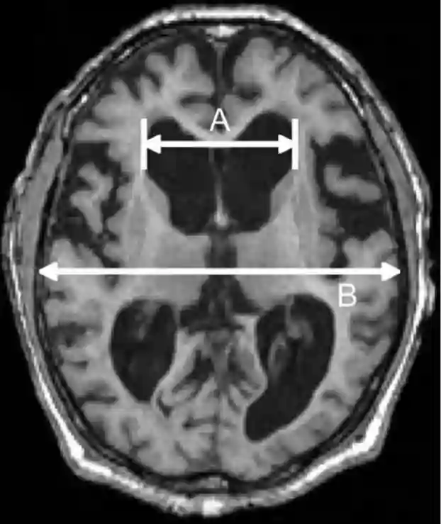 Evans Index MRI