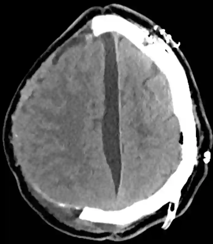 Interhemisphärisches Hygrom im CT
