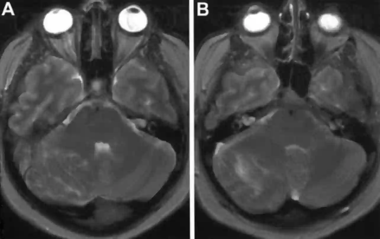Lhermitte Duclos Syndrom MRI