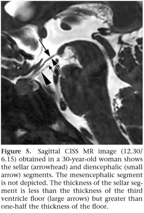 Liliequistmembran MRI