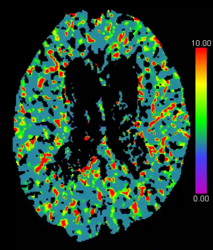 MTT CT Perfusion