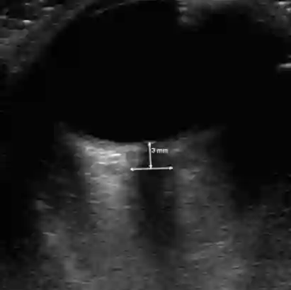 ONSD Ultraschall
