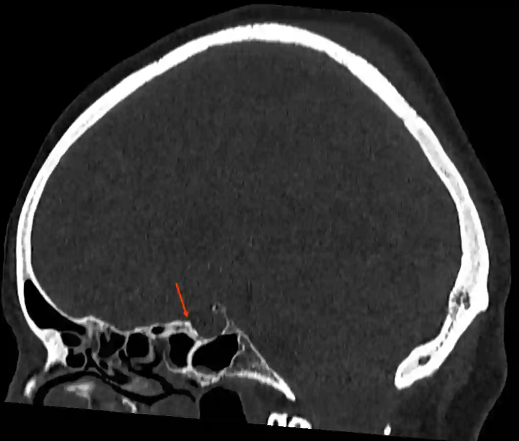 Tuberculum sellae im CT