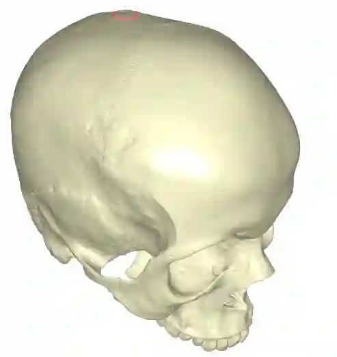 Vertex am Schädel