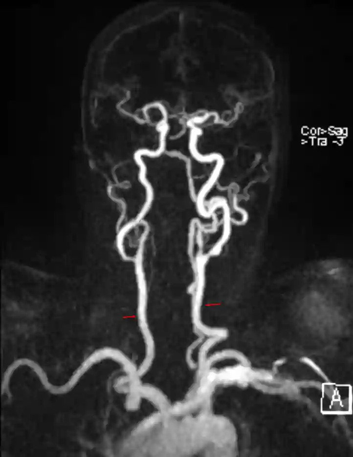 Arteria carotis communis im MRI