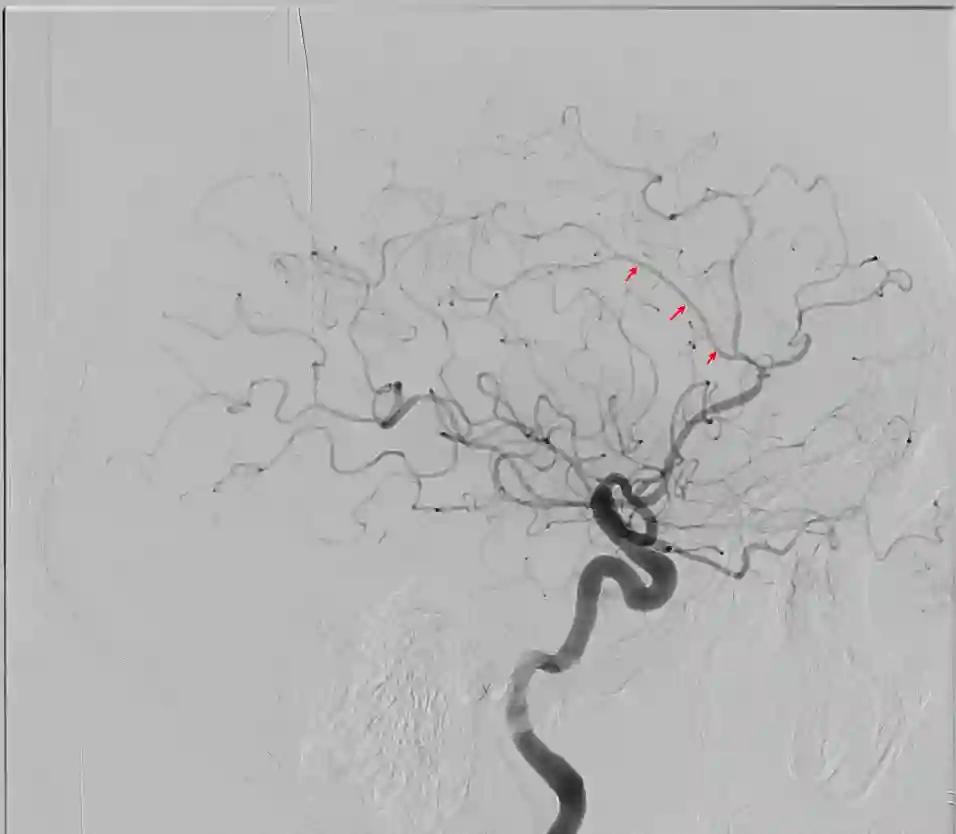 Angiographie der Arteria pericallosa