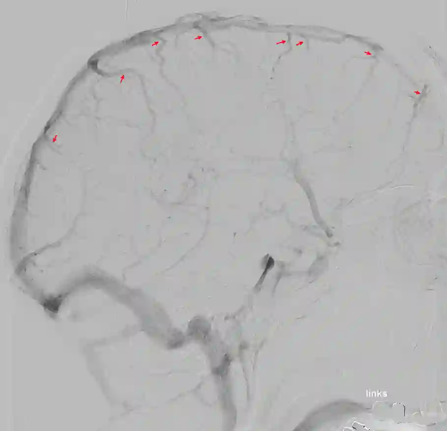 Brückenvenen in einer Angiographie