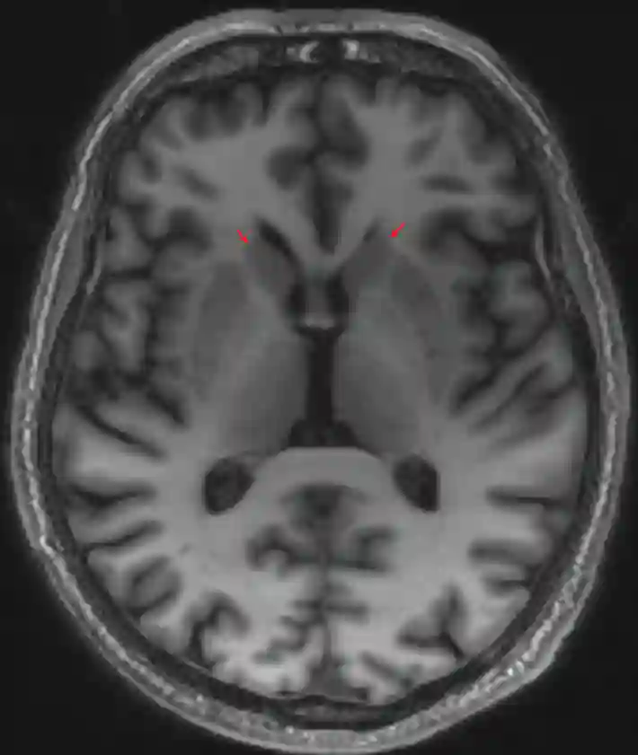 Caput nuclei caudati im MRI