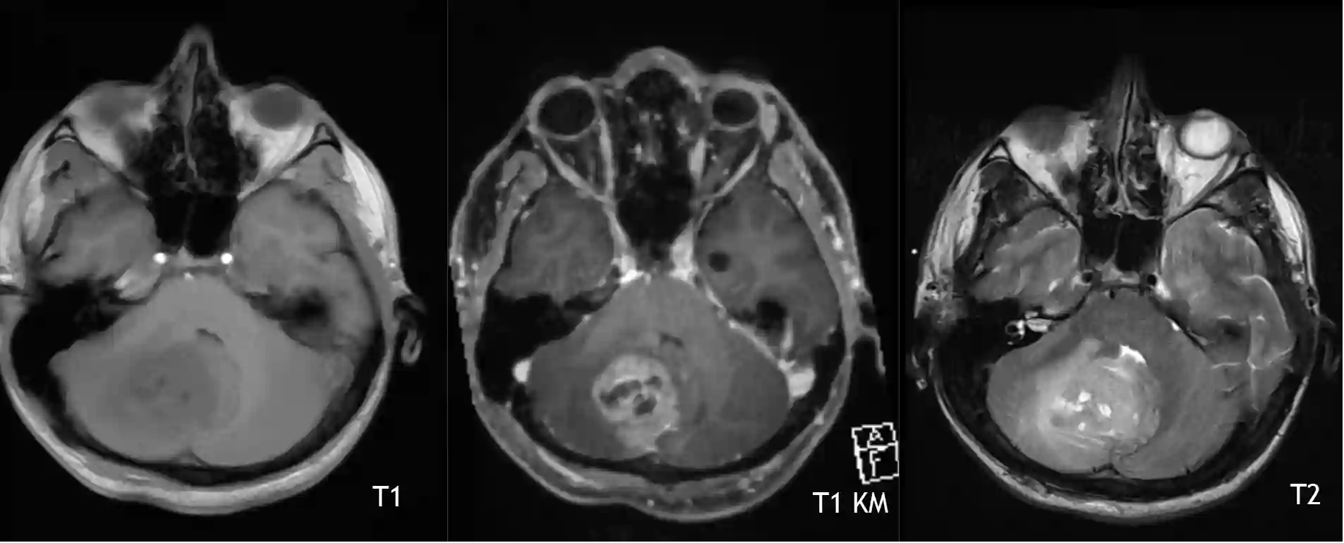Medulloblastom im Cerebellum