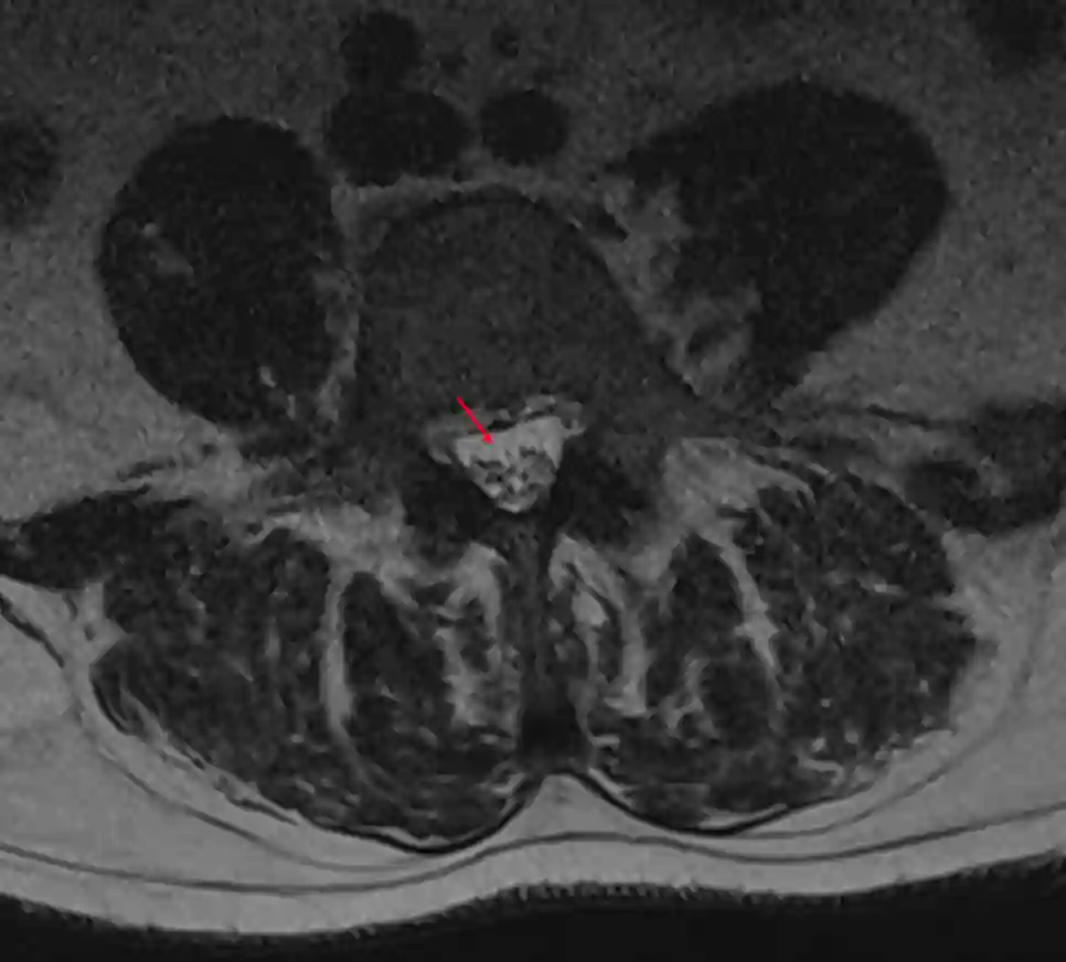 Cisterna lumbalis MRI