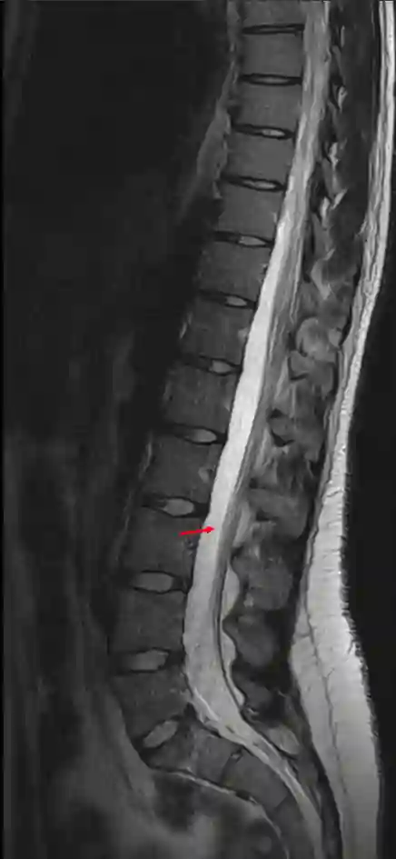 Cisterna lumbalis im MRI