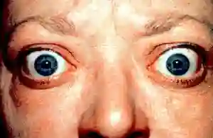 Exophthalmus