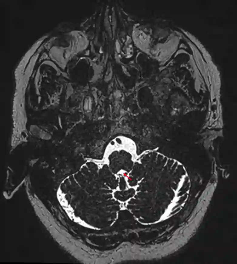Foramen magendie im MRI