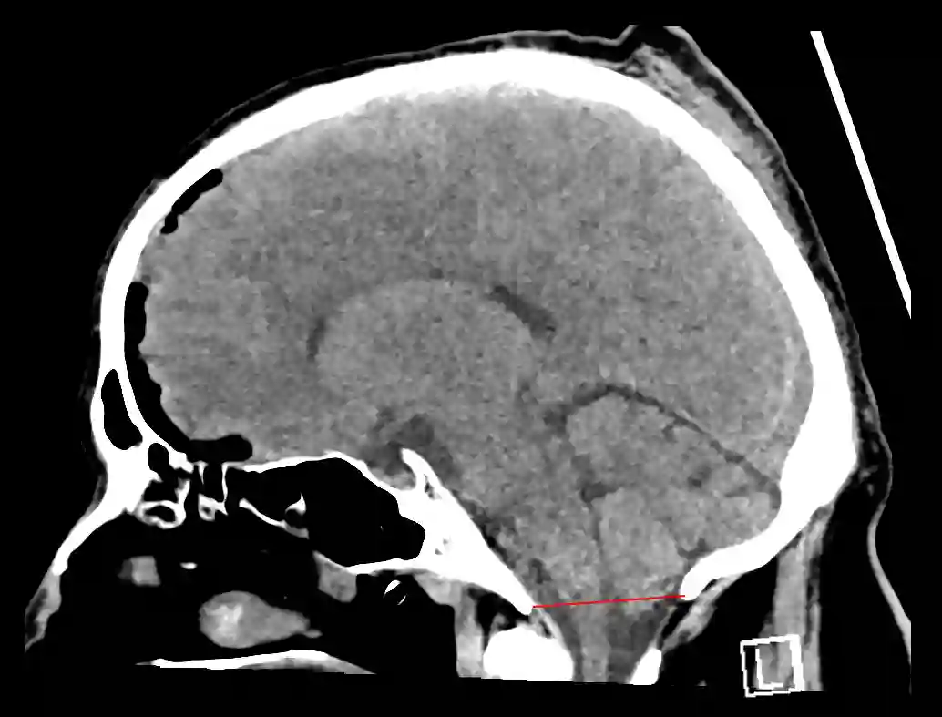 Foramen Magnum Ars Neurochirurgica Foramen Magnum Ars Neurochirurgica