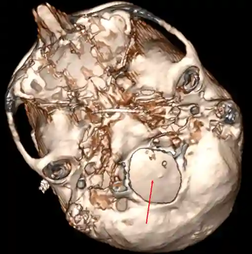 Foramen magnum in einer CT Rekonstruktion