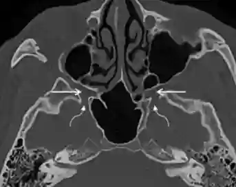Fossa pterygopalatina im CT