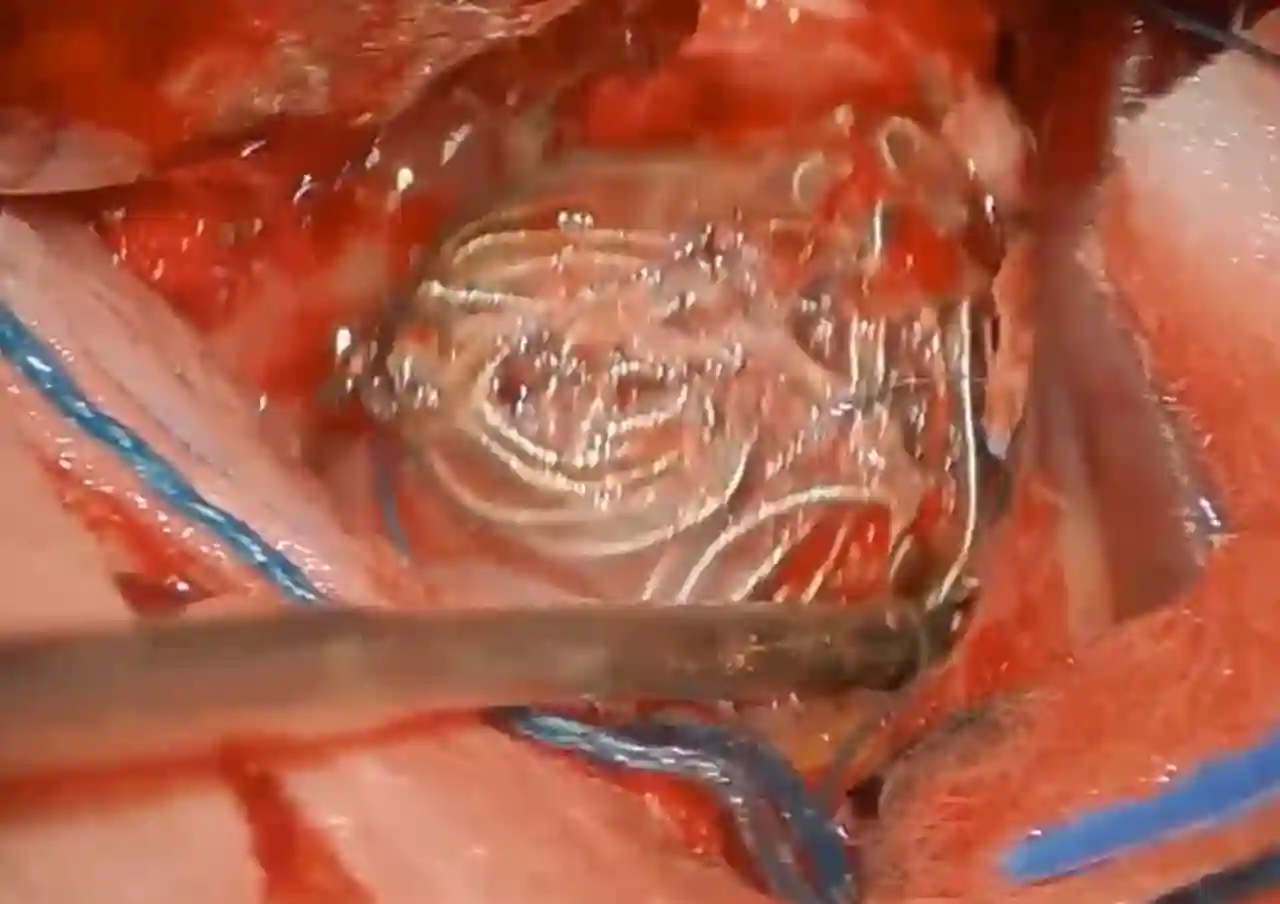 Gecoiltes Aneurysma intraoperativ