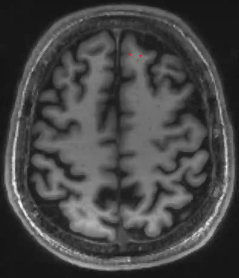 Graue Substanz MRI