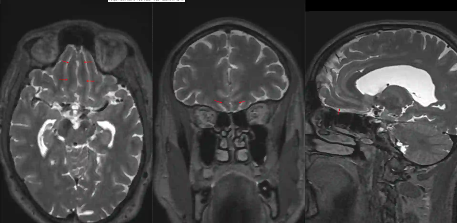 Gyrus rectus im MRI