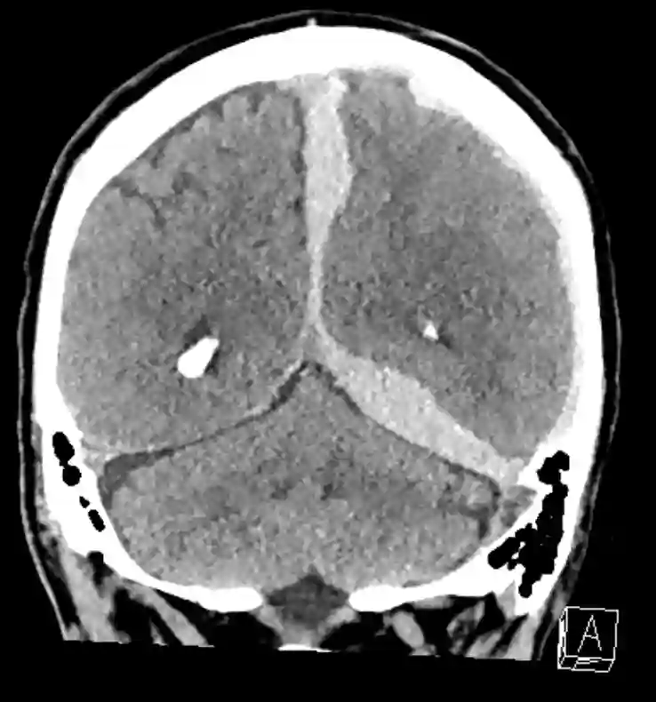 Interhemisphärisches Subduralhämatom
