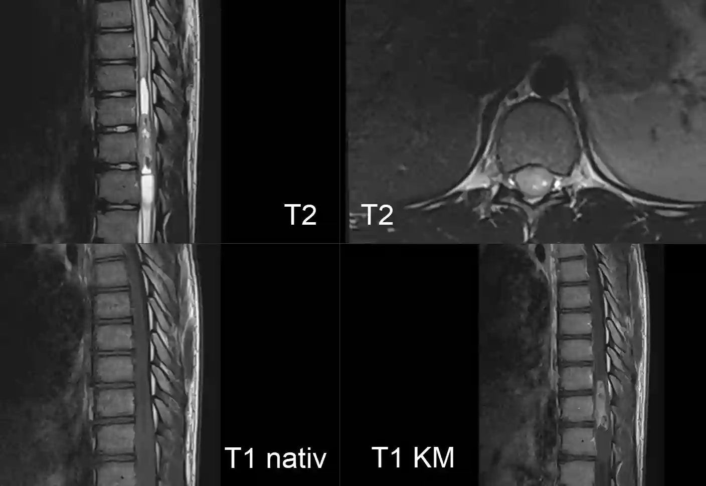 Intramedulläres Ependymom im MRI