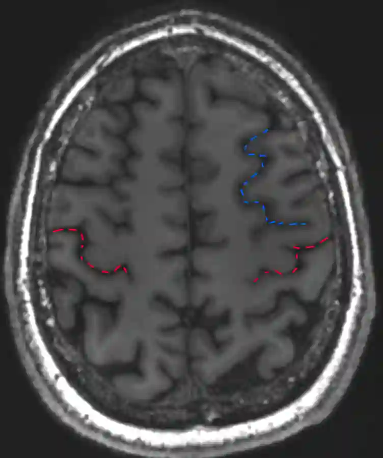 L-Sign Sulcus centralis