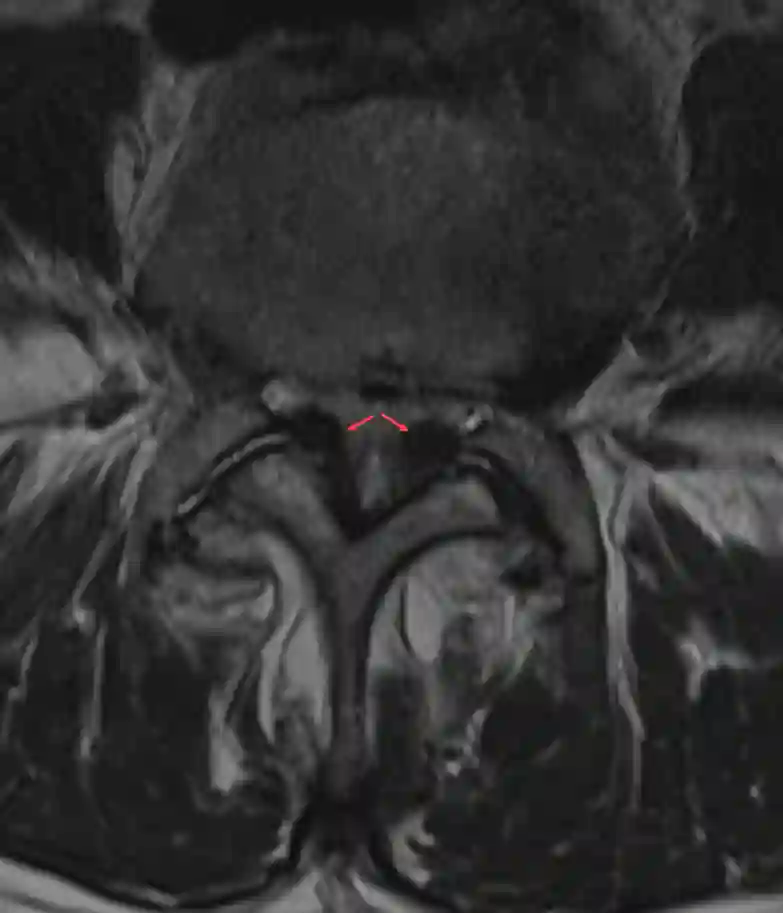 Absolute Spinalkanalstenose durch Ligamentum flavum Hypertrophie
