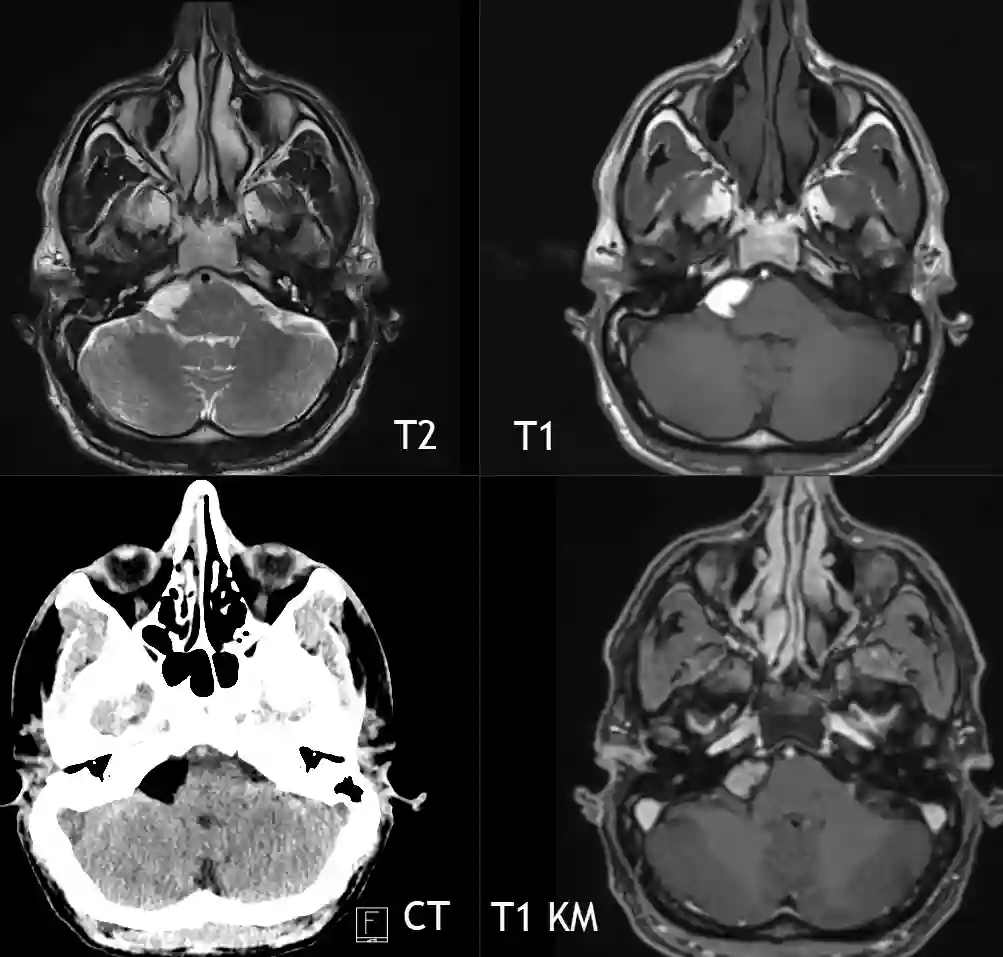 Intrakranielles Lipom CT und MRI