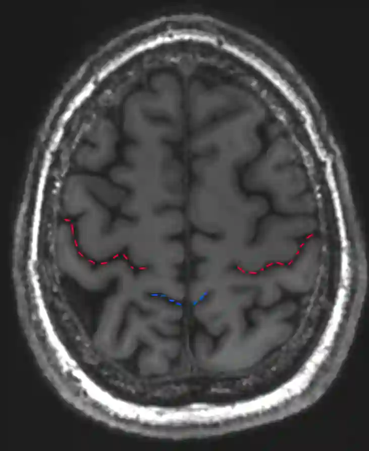 Bracket Zeichen zur Identifikation des Sulcus centralis