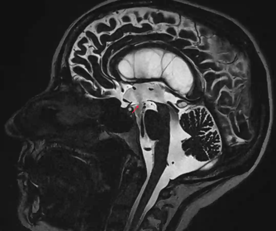 CISS MRI nach Drittventrikulostomie