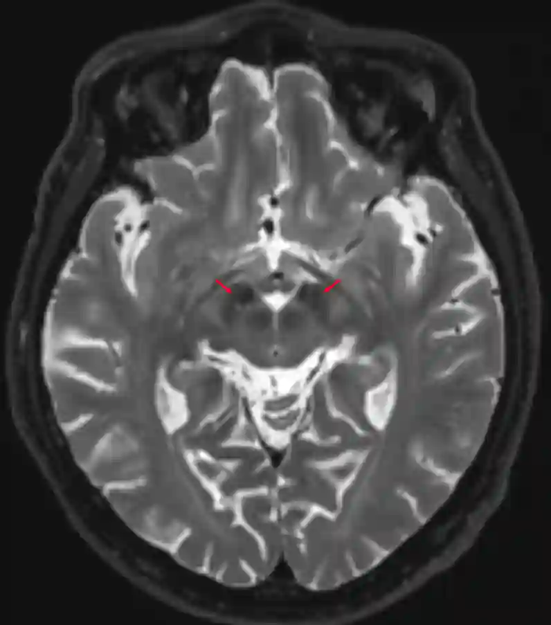 Nucleus subthalamicus MRI T2