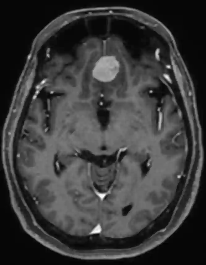 Olfaktoriusmeningeom MRI