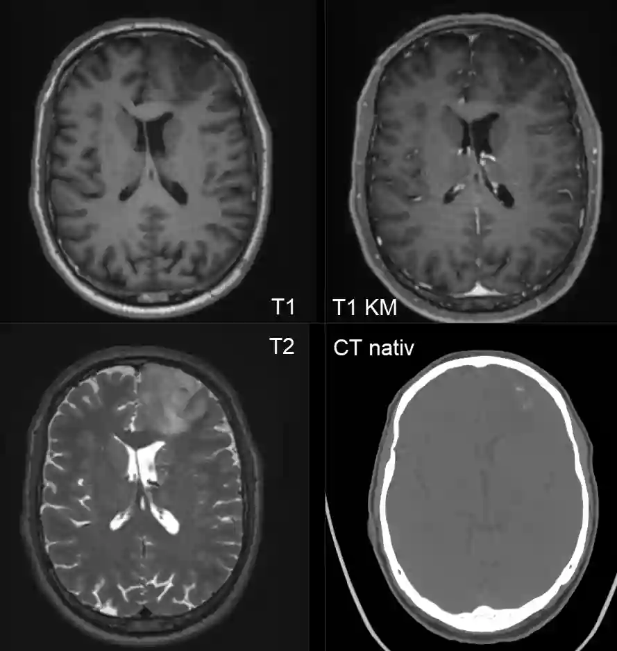 Oligodendrogliom im MRI und CT