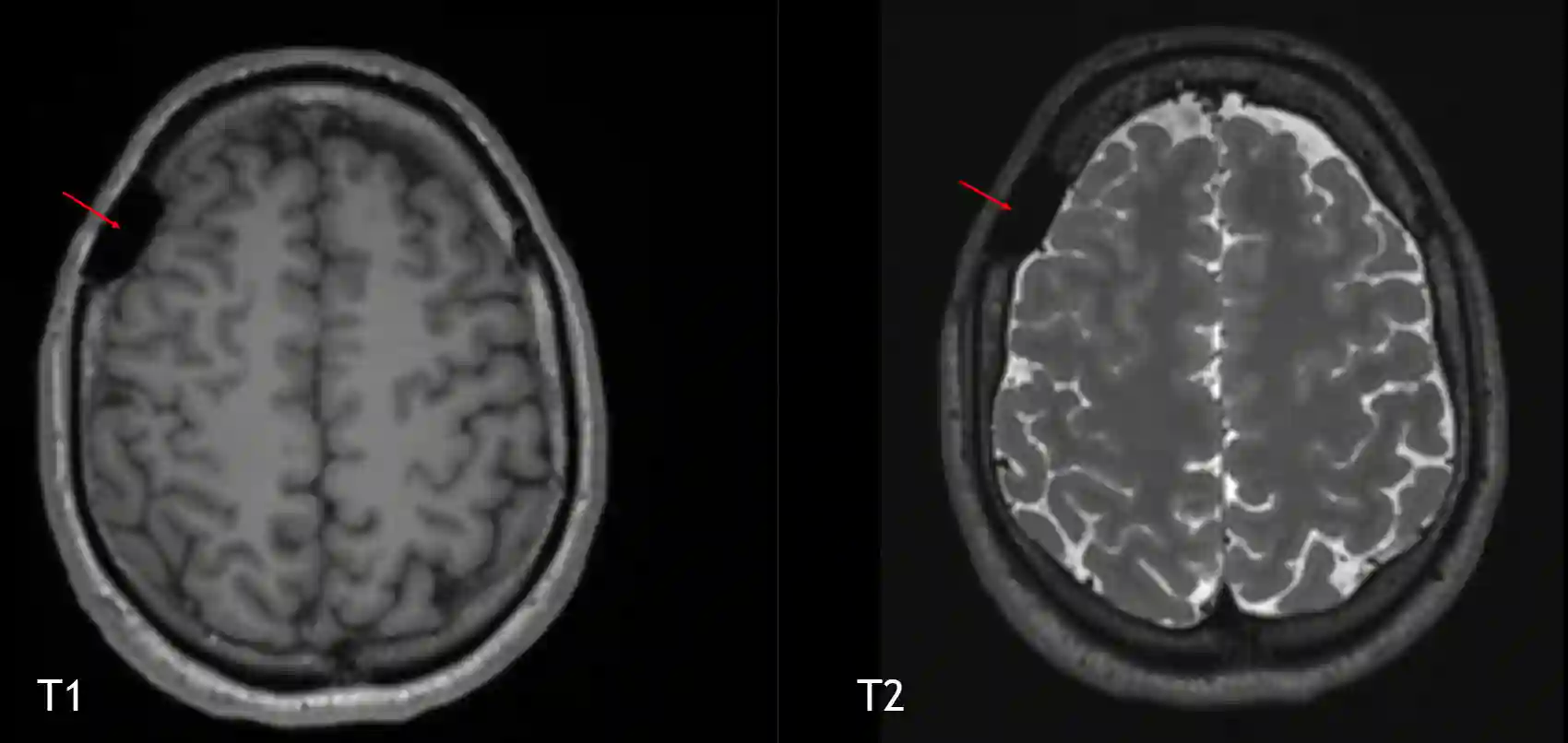 Palacosplastik im MRI
