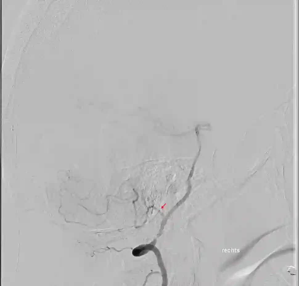 PICA digitale Subtraktionsangiographie