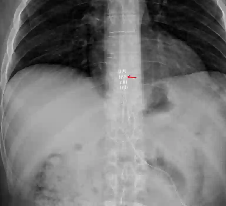 Abbott Penta Plattenelektrode