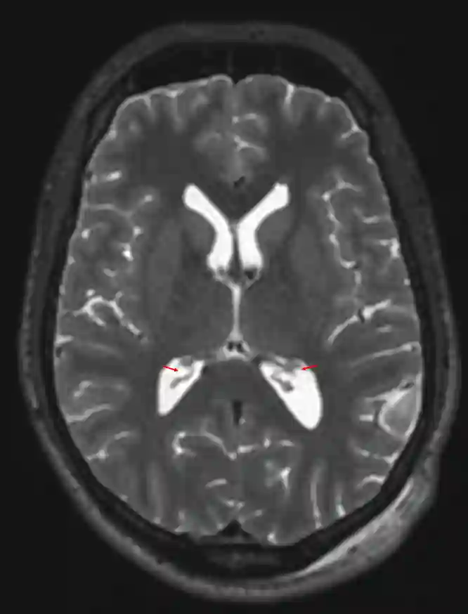 Plexus choroideus im MRI