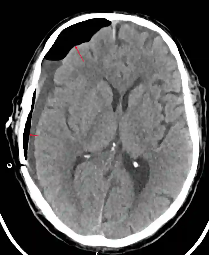 Postoperatives Pneumencephalon