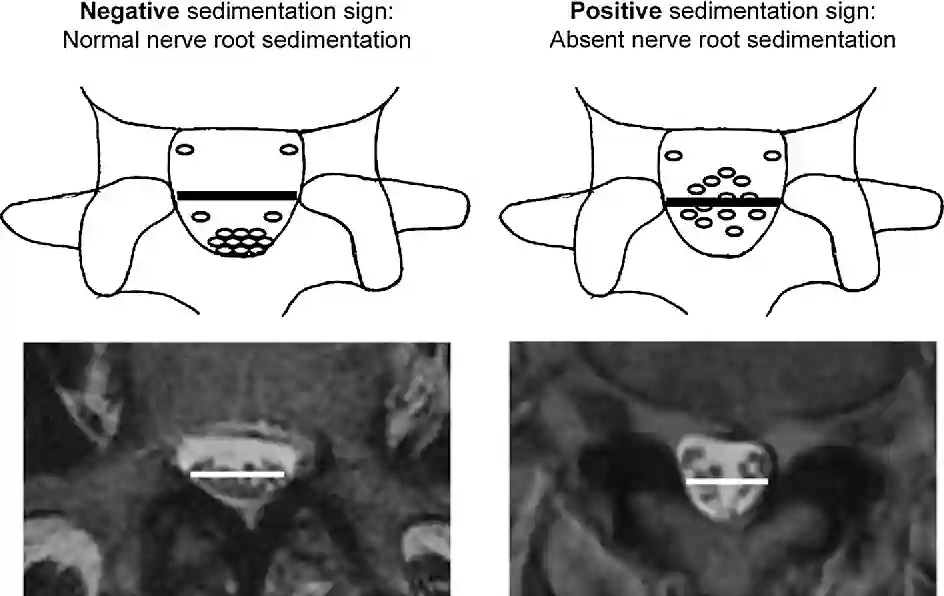 Sedimentation Sign