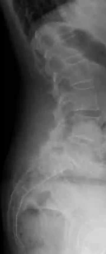 Spondylolisthese LWK5/SWK1
