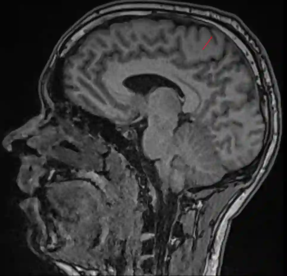 Sulcus centralis sagittal MRI