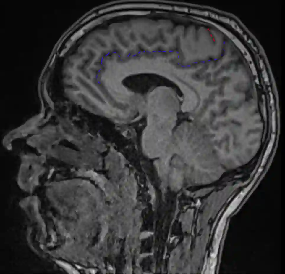 Sulcus cinguli und Sulcus centralis im MRT