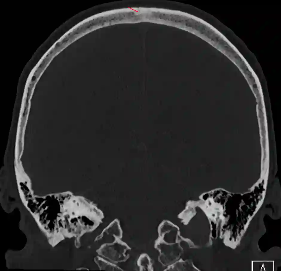 Sutura sagittalis im CT